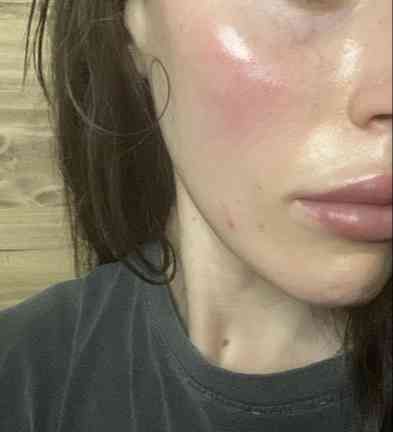Acne Care Kit, skin after use