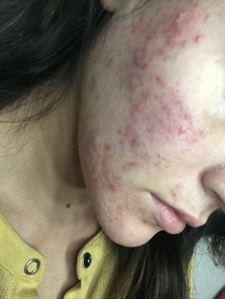 Acne Care Kit, skin before use