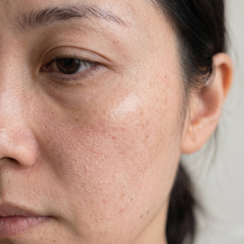 Skin close-up at week 2 to 3
