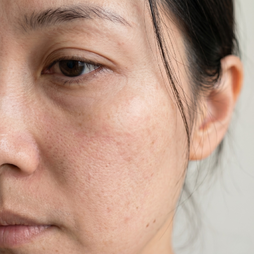 Skin close-up at week 4, visibly clearer