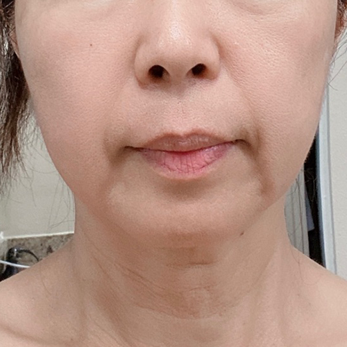 Firming Kit, skin before use